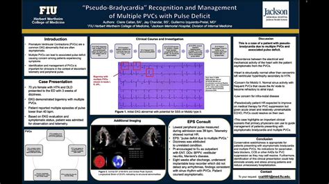 pseudo bradycardia pvcs.